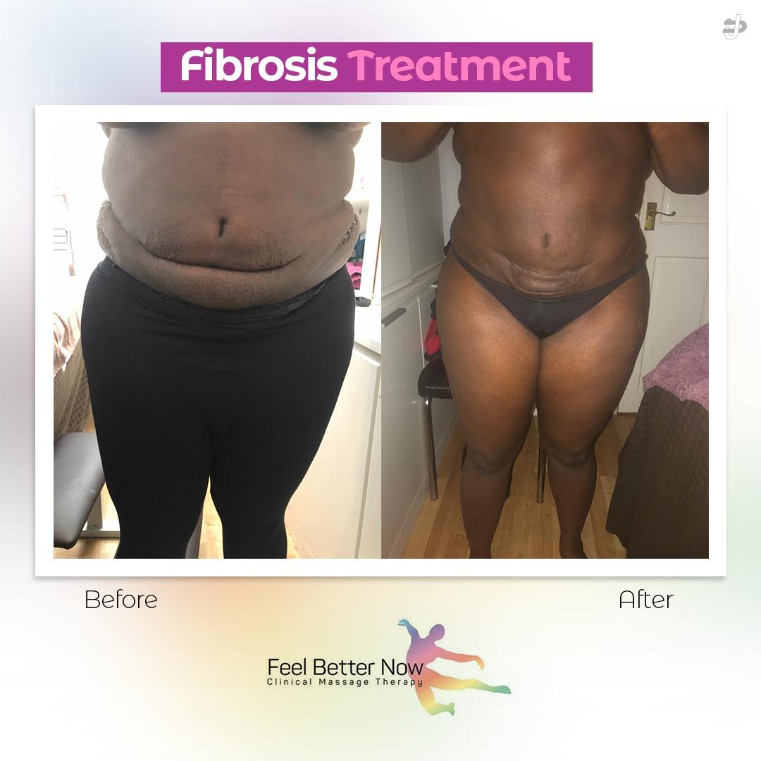 Fibrosis Treatment