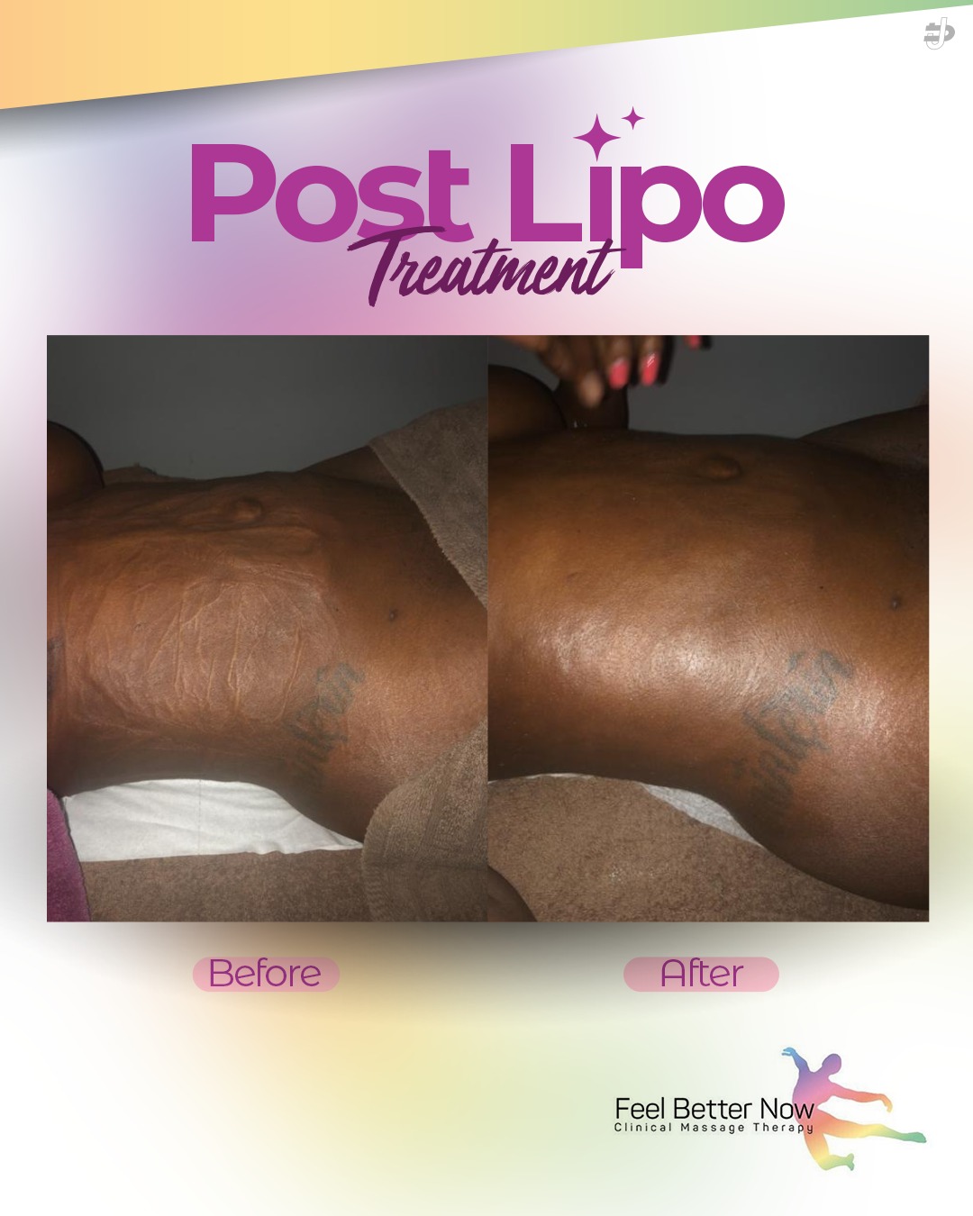 Post Lipo Treatment