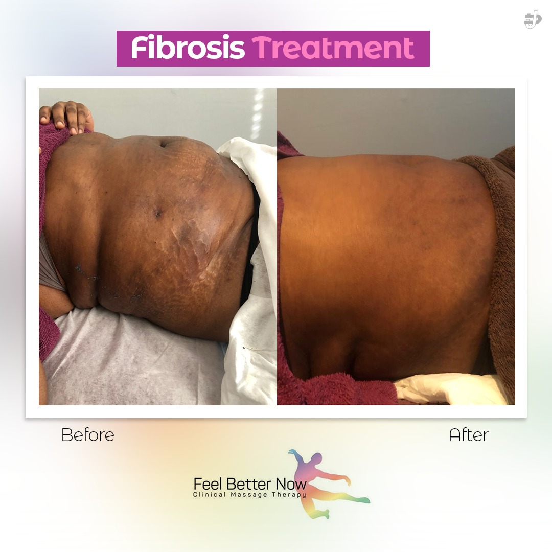 Fibrosis Treatment